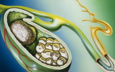 Sỏi mật 43mm điều trị thế nào, có dùng TPBVSK Kim Đởm Khang được không?