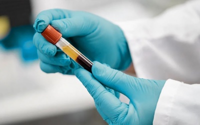 Xét nghiệm máu dự đoán chính xác bệnh Alzheimer trước khi có triệu chứng