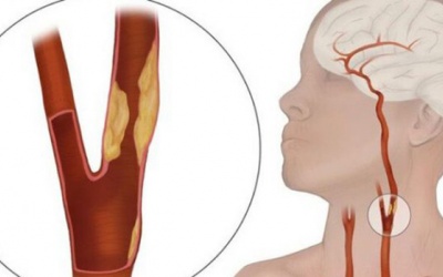 Xơ vữa động mạch cảnh: Những điều bạn cần biết