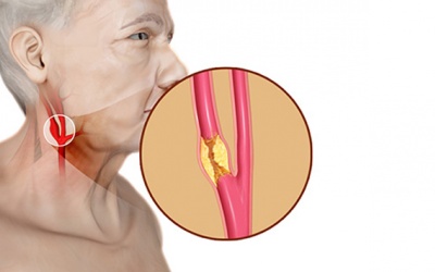 Đặt stent động mạch cảnh diễn ra thế nào?