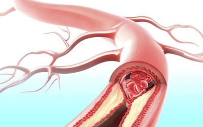 Người mắc bệnh tim mạch phòng nguy cơ xơ vữa động mạch thế nào? 