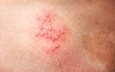 Mẹo đơn giản hỗ trợ chữa zona thần kinh tại nhà