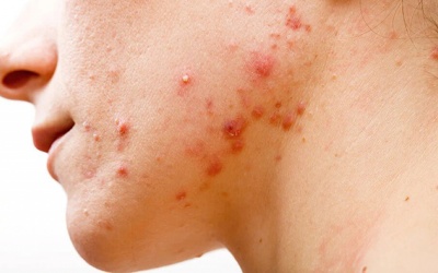 Làm thế nào để đánh bay mụn bọc 'cứng đầu' trên da?