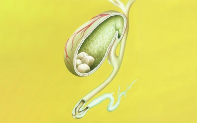 Sỏi mật tăng từ 11mm lên 17mm có nên phẫu thuật không?