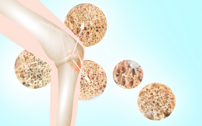 Những dấu hiệu cho thấy cơ thể bạn đang thiếu calci