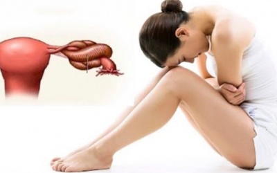 Những điều cần biết về u nang buồng trứng xoắn