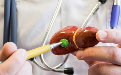 Sỏi mật kích thước 13,5mm đã phải mổ chưa?