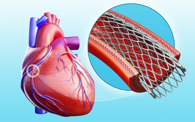 Phải đặt stent mạch vành nhưng dùng thuốc thấy đỡ có cần đặt nữa không?