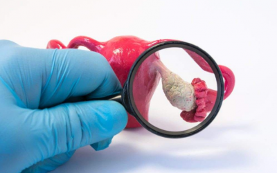 Buồng trứng đa nang liên quan thế nào tới bệnh trầm cảm?