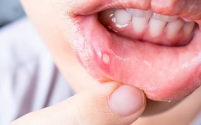 Cách tốt nhất để giảm đau loét miệng là gì?