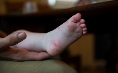 4 cách cải thiện chân tay miệng tại nhà