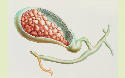 Sỏi túi mật 5,1mm nên chữa trị thế nào?