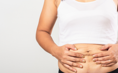 Mẹo ngăn ngừa và cải thiện da chảy xệ sau giảm cân