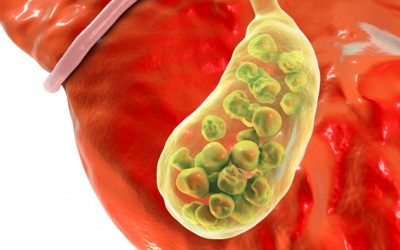 Sỏi đầy túi mật, chưa đau uống TPBVSK Kim Đởm Khang được không?