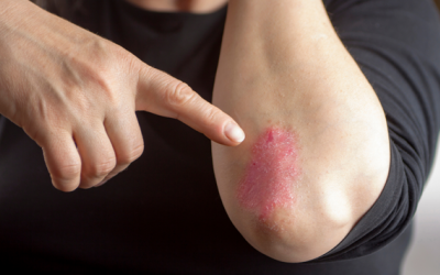 Vảy nến có lây không, cải thiện bệnh thế nào?