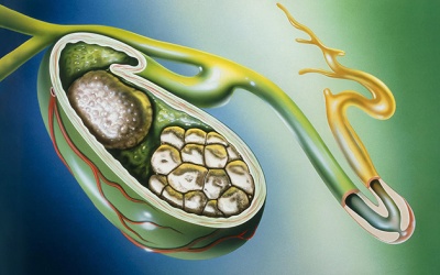 Đám sỏi mật 8,5mm nên chữa trị thế nào?