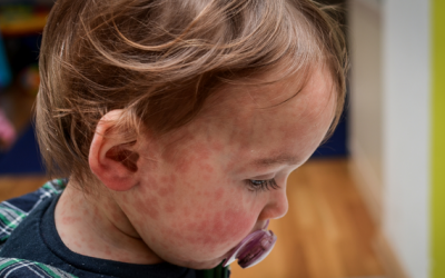 Những kiến thức cần biết trước khi bệnh sởi vào mùa