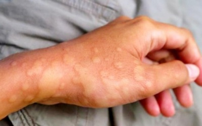 Biện pháp phòng ngừa dị ứng thời tiết trong mùa xuân