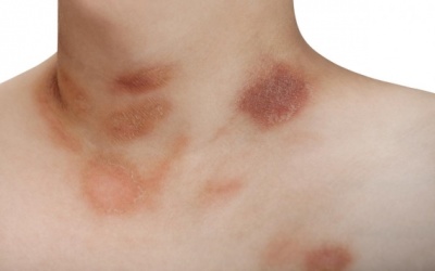 Cách chăm sóc da bị vảy phấn hồng tại nhà