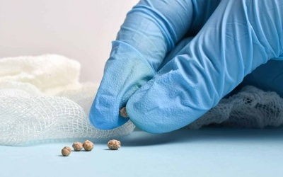 Sỏi túi mật 3mm là gì, có nguy hiểm không?