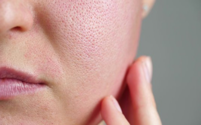 Mẹo thu nhỏ lỗ chân lông tự nhiên tại nhà