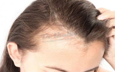 Một số phương pháp cải thiện tình trạng rụng tóc sau sinh