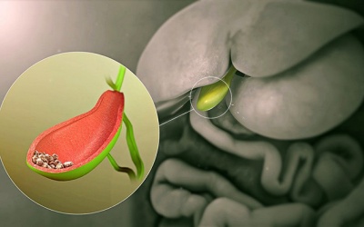 Sỏi túi mật 5mm có nguy hiểm không?
