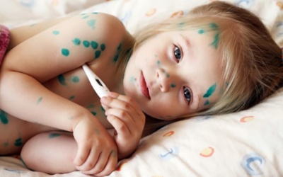 Thủy đậu vào mùa, phòng bệnh cho trẻ thế nào? 