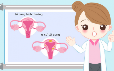 Dấu hiệu nhận biết và cách điều trị u xơ tử cung 