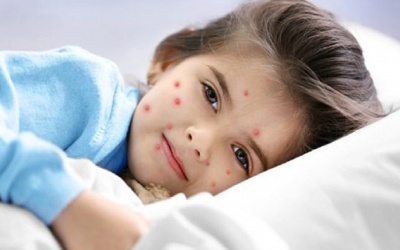 Mắc thủy đậu phải kiêng những gì?