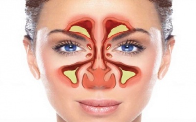 Những lầm tưởng phổ biến về xoang