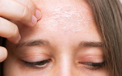 Vảy nến trên mặt cải thiện như thế nào?