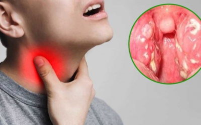 Nguyên nhân gây viêm họng hạt và cách cải thiện hiệu quả nhất