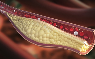 3 bài thuốc nam cải thiện máu nhiễm mỡ hiệu quả 