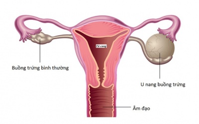 U nang buồng trứng có nguy hiểm không và cách cải thiện hiệu quả