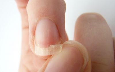 Móng tay yếu, dễ gãy có đáng lo hay không? 