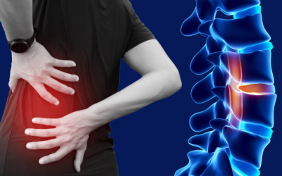 4 biến chứng thoát vị đĩa đệm nguy hiểm 