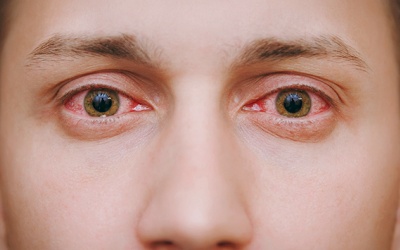 Dị ứng thời tiết gây đau, ngứa mắt, cách xử lý và phòng tránh?