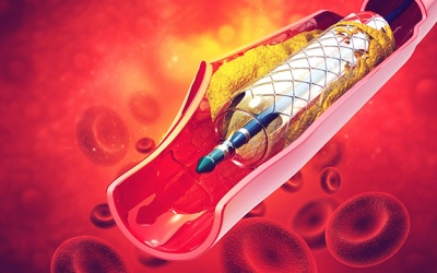 Tắc hẹp mạch vành mức độ nào cần đặt stent?