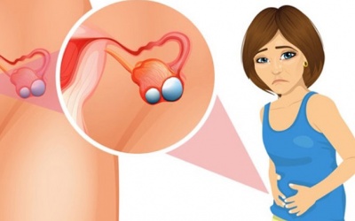 “Điểm mặt” 3 dấu hiệu cảnh báo u nang buồng trứng