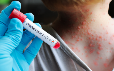 Infographic: 5 khuyến cáo của Bộ Y tế để phòng tránh thủy đậu