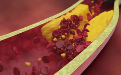 Hẹp mạch vành 75% đã phải đặt stent chưa?