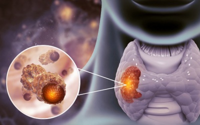 Triệu chứng thường gặp của ung thư tuyến giáp