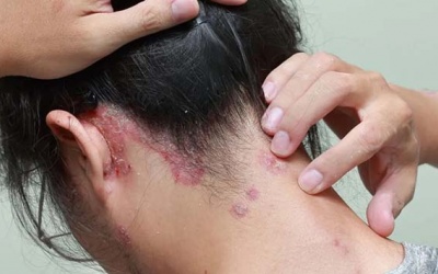 Cần làm gì để cải thiện bệnh vảy nến da đầu?