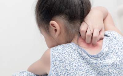 Những bệnh ngoài da trẻ thường gặp trong mùa Hè