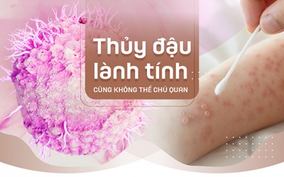 Thủy đậu lành tính cũng không thể chủ quan