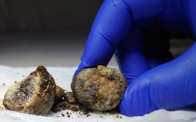 Tổng hợp một số câu hỏi về sỏi mật 2cm