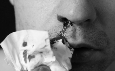 Chảy máu cam nhiều tháng do đỉa ký sinh trong mũi