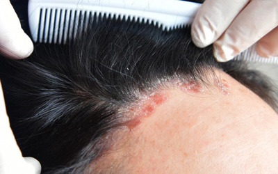 Cách xử lý vảy nến da đầu với các nguyên liệu trong nhà  