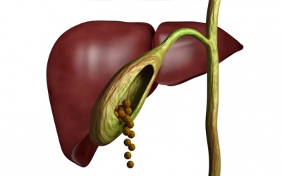 Sỏi túi mật 10,5mm có nguy hiểm không, nên chữa thế nào?